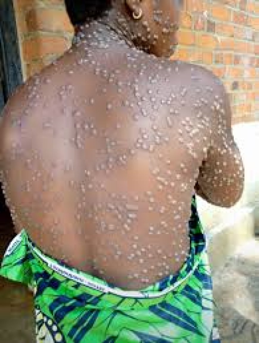 11 More Mpox Cases Recorded