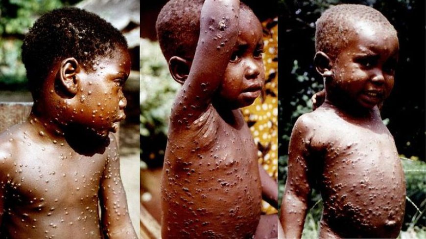 Ghana Records Its First Monkey Pox Death, 23 Confirmed Active Cases