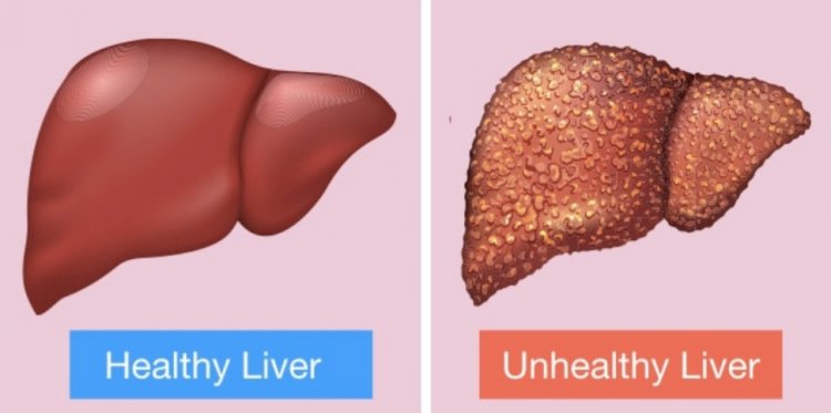 Tips To Protect Your Liver From Damage