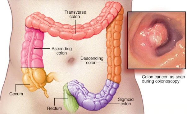 Colon Cancer