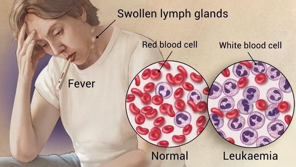 Leukemia