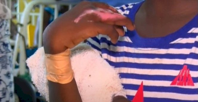 Girl Needs Urgent Surgery To Save Fingers After Guardian Forced Her Hand Into Boiling Water Over ¢2