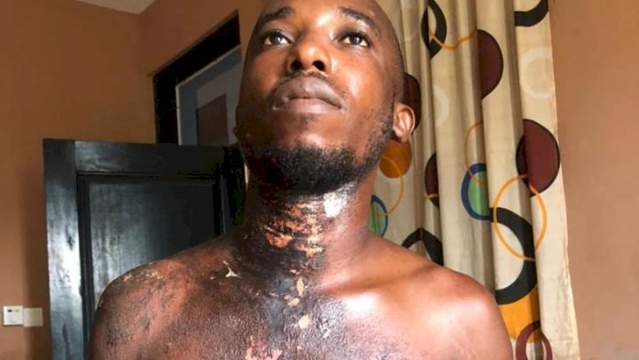 Woman Bathes Husband With Acid