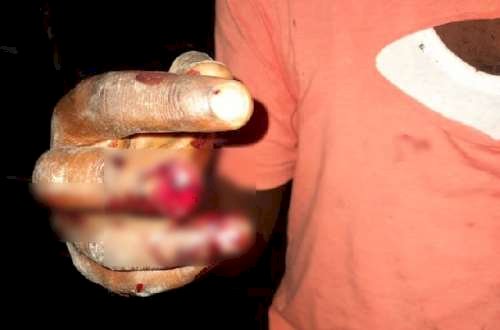 Teacher Attacked At Kpetoe, Sustains Deep Cuts