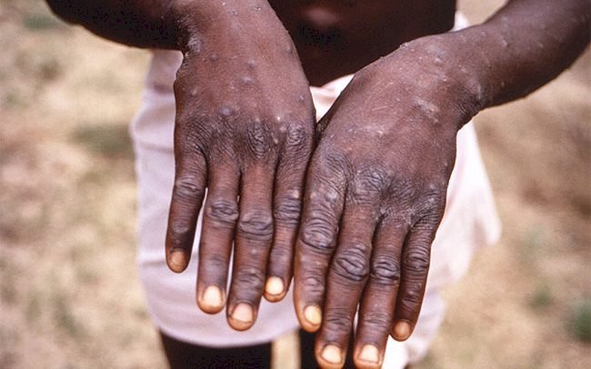 Bono Region Records More Monkeypox Cases