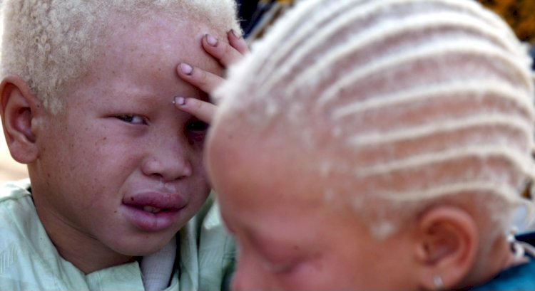 South Africa: Woman Sentenced To 20 Years Imprisonment For Trying To Sell Albino Child