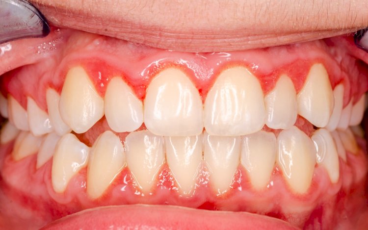 Periodontitis - Gum Disease