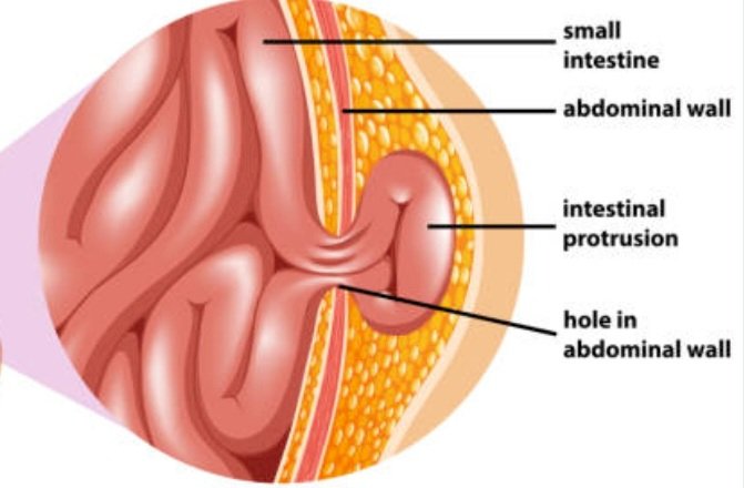 Hernia: All You Need To Know